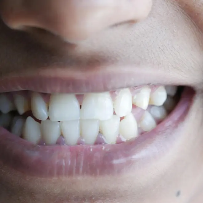 Antes y después de tratamiento de ortodoncia invisible